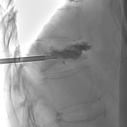 fluoroscopic image, cement injection during percutaneous kyphoplasty