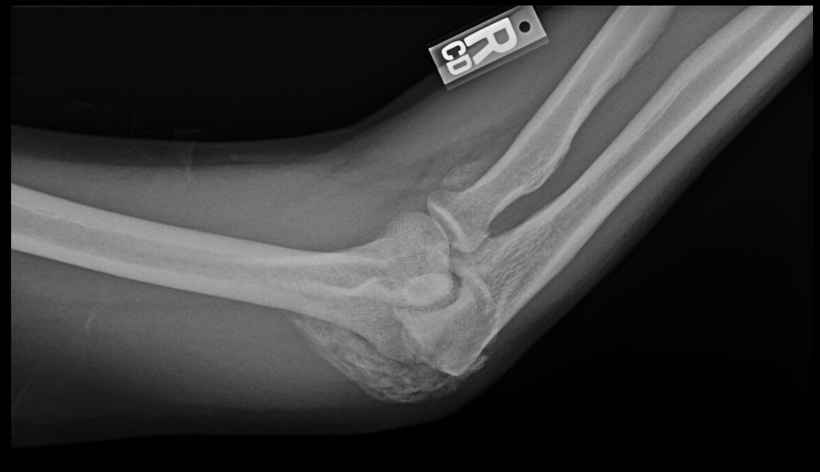 Heterotopic ossification of the elbow