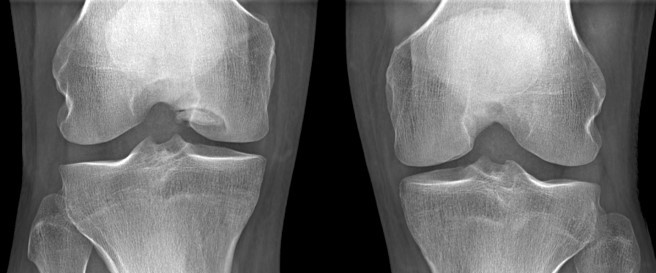 AP radiograph knees - medial femoral condyle Grade 2 osteochondritis dissecans
