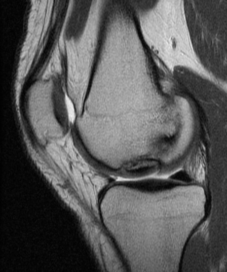 MRI PD sagittal knee - medial femoral condyle Grade 2 osteochondritis dissecans
