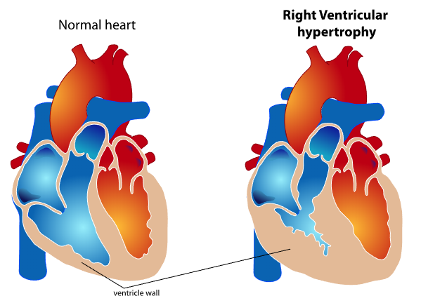 <p>Right Ventricular Wall&nbsp;Thickening in Ventricular Hypertrophy