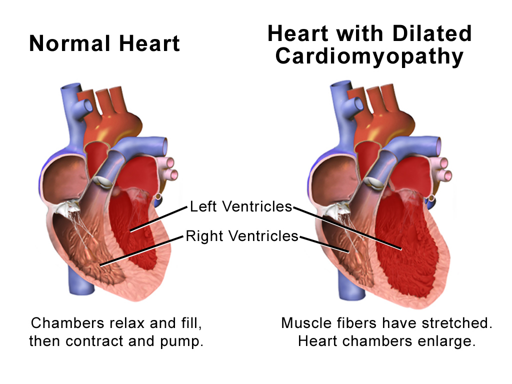 <p>Cardiac Dilated Cardiomyopathy&nbsp;</p>