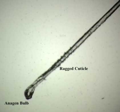 Loose anagen hair syndrome. Note the ragged cuticle and bulb shape denoting anagen hair.