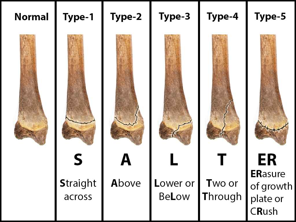 <p>Salter-Harris Classification of Epiphyseal Injuries</p>