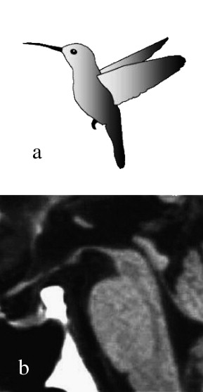 (a) Hummingbird, (b) mid-sagittal plain MRI in PSP