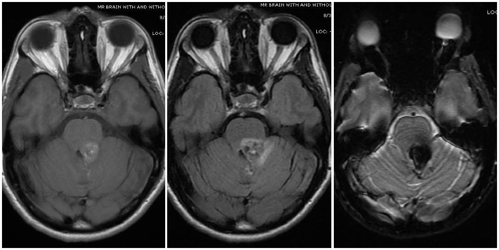 Magnetic resonance imaging depicts a cavernous malformation in the left middle cerebellar peduncle of a patient who presented with right sided facial numbness and ataxia
