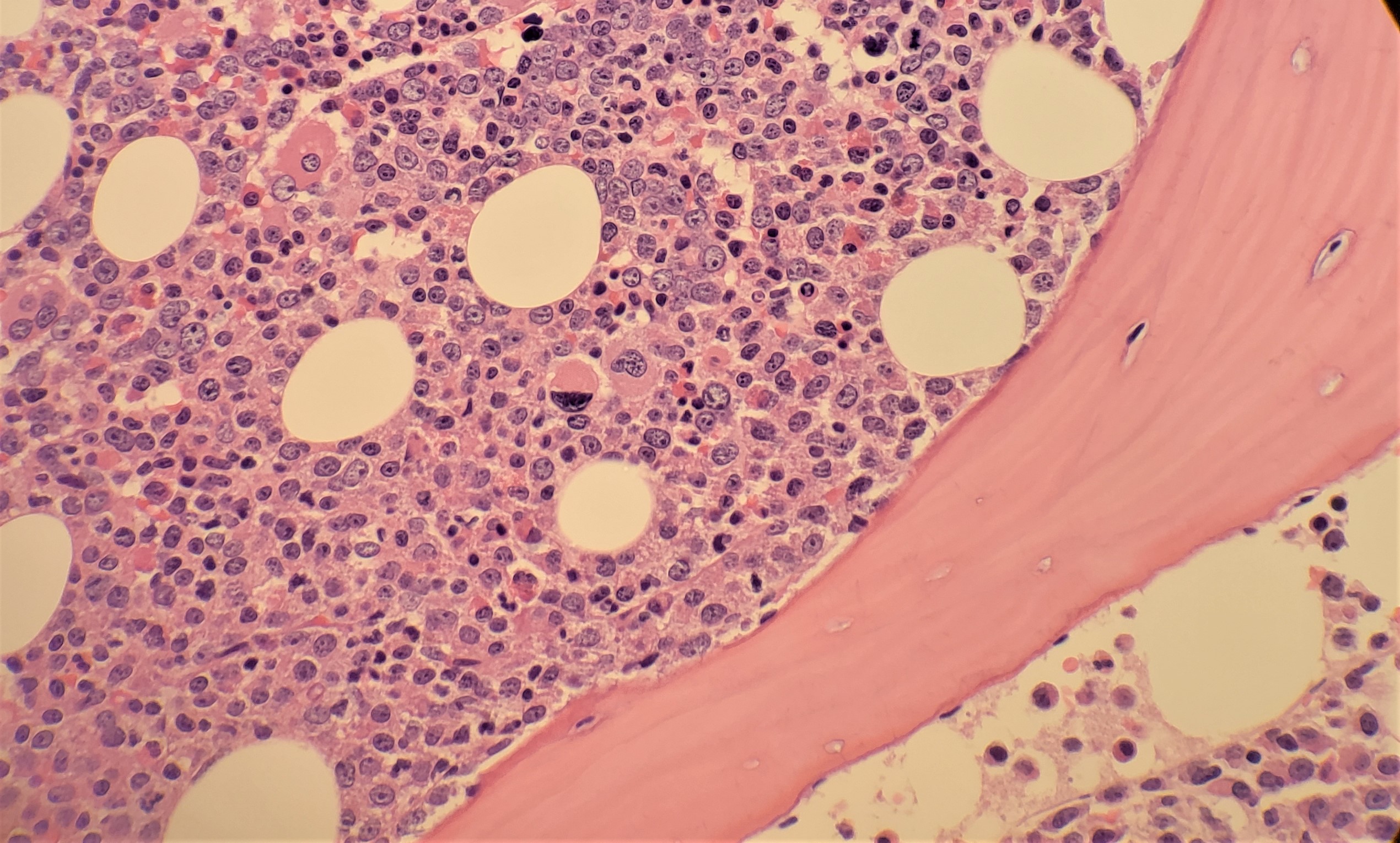 Bone marrow biopsy of Chronic Myeloid Leukemia showing hypercellularity and expansion of immature granulocytic paratrabecular