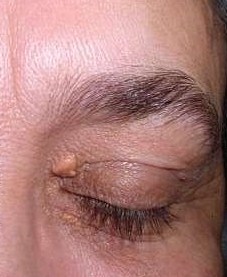 <p>Xanthelasma palpebrarum. Yellowish deposits over the left upper and lower eyelid.</p>