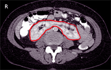 <p>CT Scan, Horseshoe Kidney</p>
