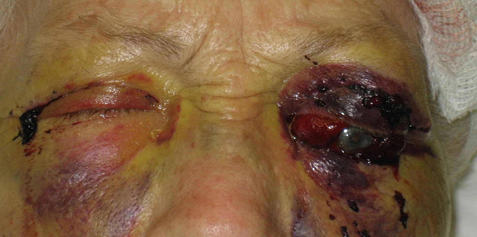 Patient developed severe pain in the left eye and orbit after uneventful upper blepharoplasty