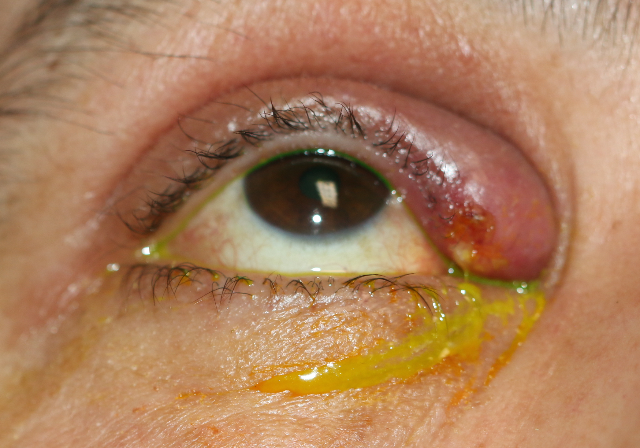 Upper canaliculitis with swelling of the medial upper eyelid, mucoid discharge from the upper punctum and a history of previous placement of a Herrick intra-canalicular plug