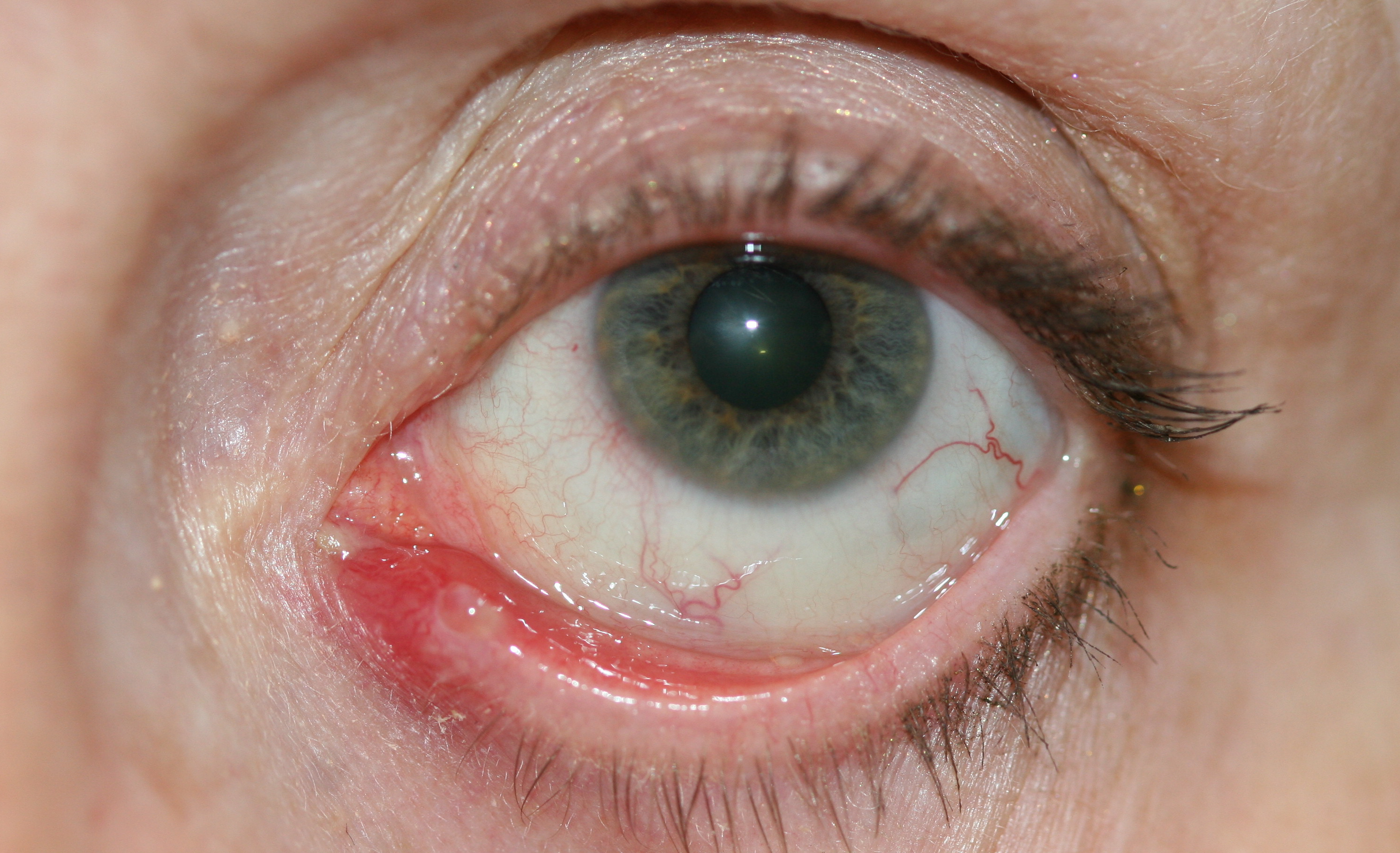 60-year-old female presents with a six-month history of swelling of the medial lower eyelid, discharge and tenderness