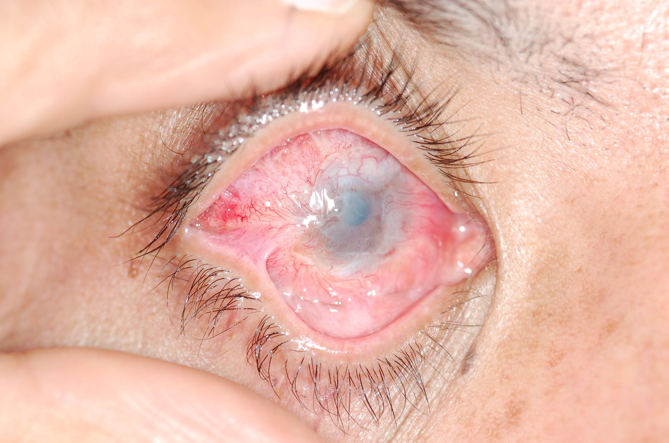 Severe alkali burn to the right eye
