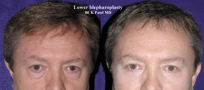 Before and after photographs of lower trans conjunctival blepharoplasty with lateral canthal tightening and CO2 laser application to the skin, together with fat transposition over the inferior orbital rim