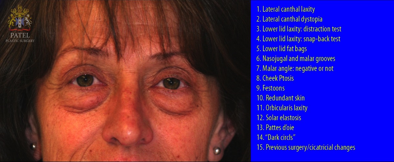 Assessment of lower eyelids prior to lower blepharoplasty needs to be systematic and complete