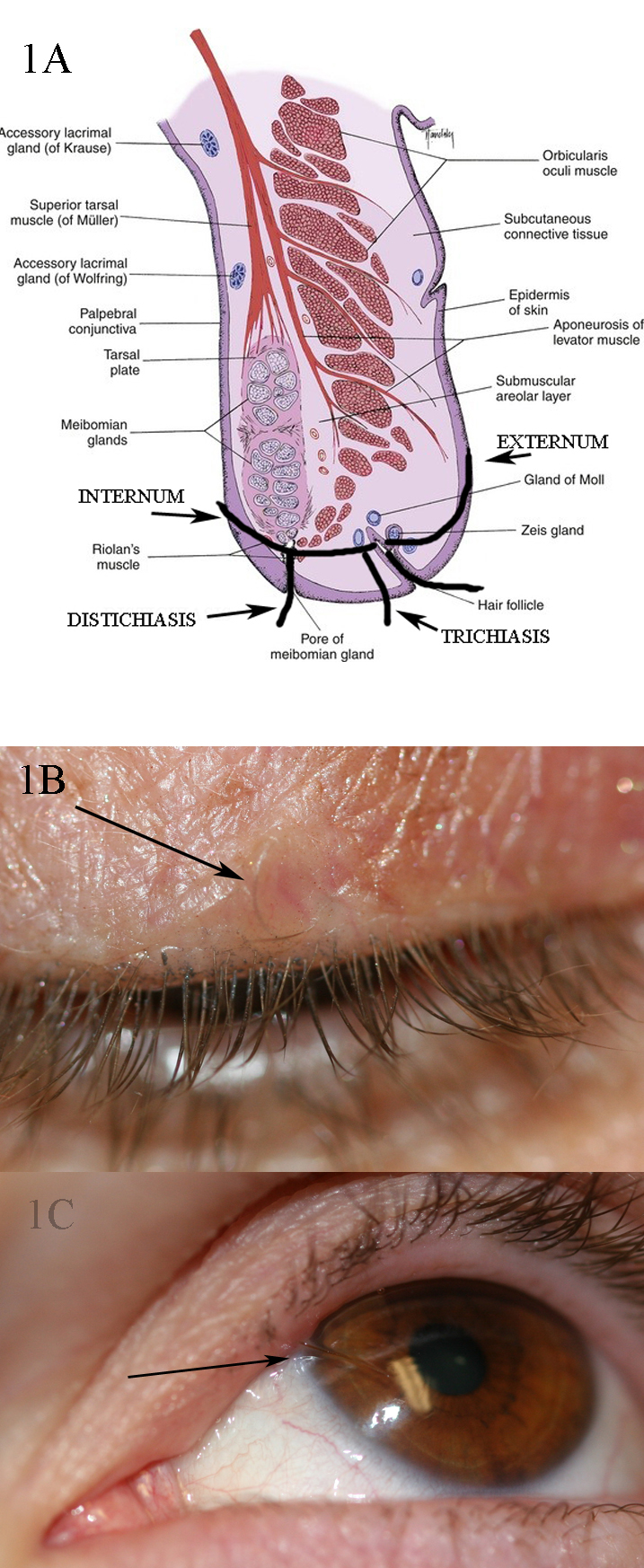 1A: shows the different orientations of lashes in trichiasis, distichiasis, cilia incarnata internum and cilia incarnata externum