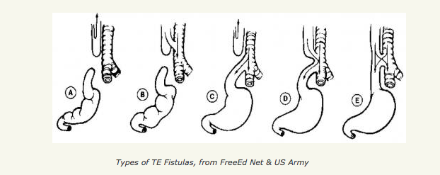 <p>Types of Tracheoesophageal Fistulas. This image shows the differences between tracheoesophageal fistula subtypes</p>