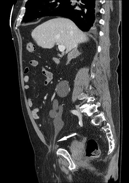 Computed tomography abdomen / pelvis with intravenous contrast of an ureteroinguinal hernia