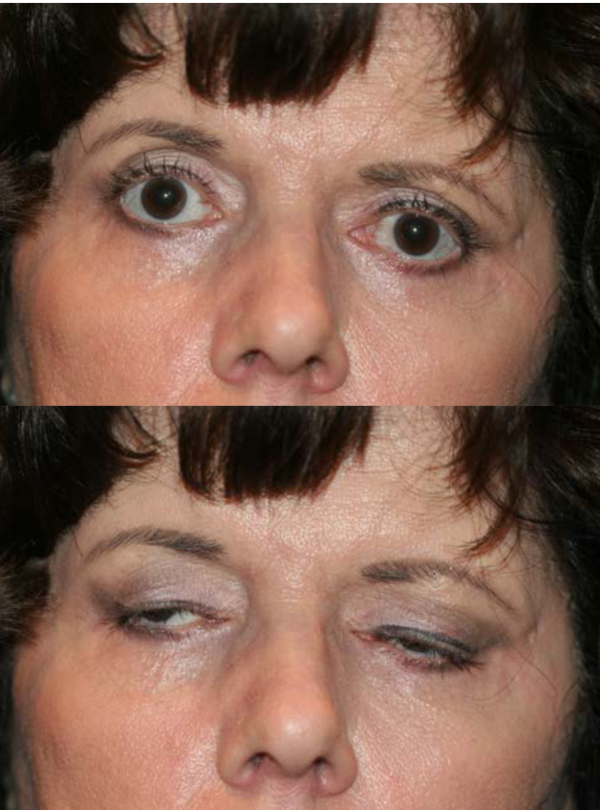 Lagophthalmos: patient with over-aggressive upper and lower blepharoplasty with shortage of skin and over-aggressive removal of orbicularis muscle