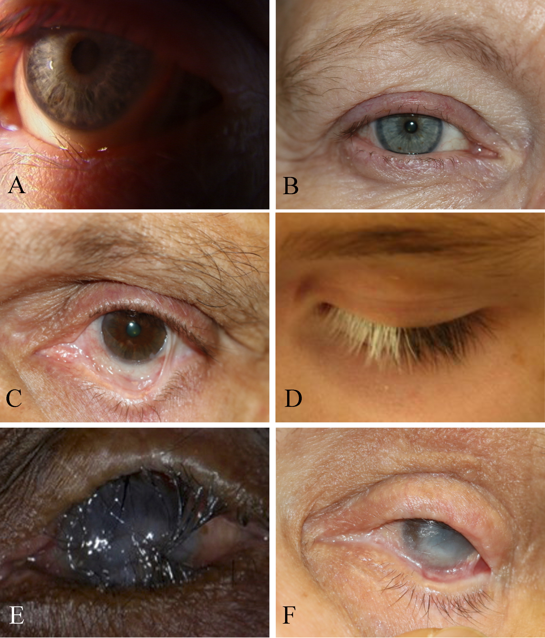 <p>Eye Disorders and Trachoma-Associated Symptoms