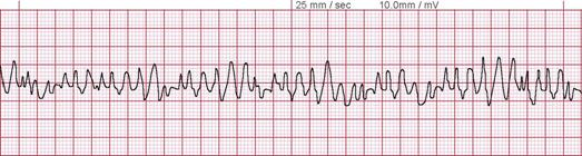 <p>Ventricular Fibrillation on Electrocardiography
