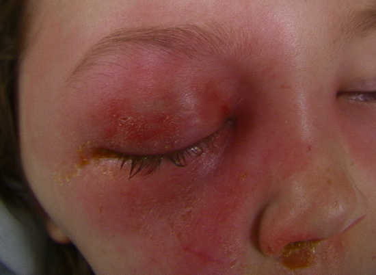 14-year-old female presents with swelling of the right periorbital tissues developing over one week with nasal congestion, pain, double vision and difficulty opening the eyelids and decreased vision