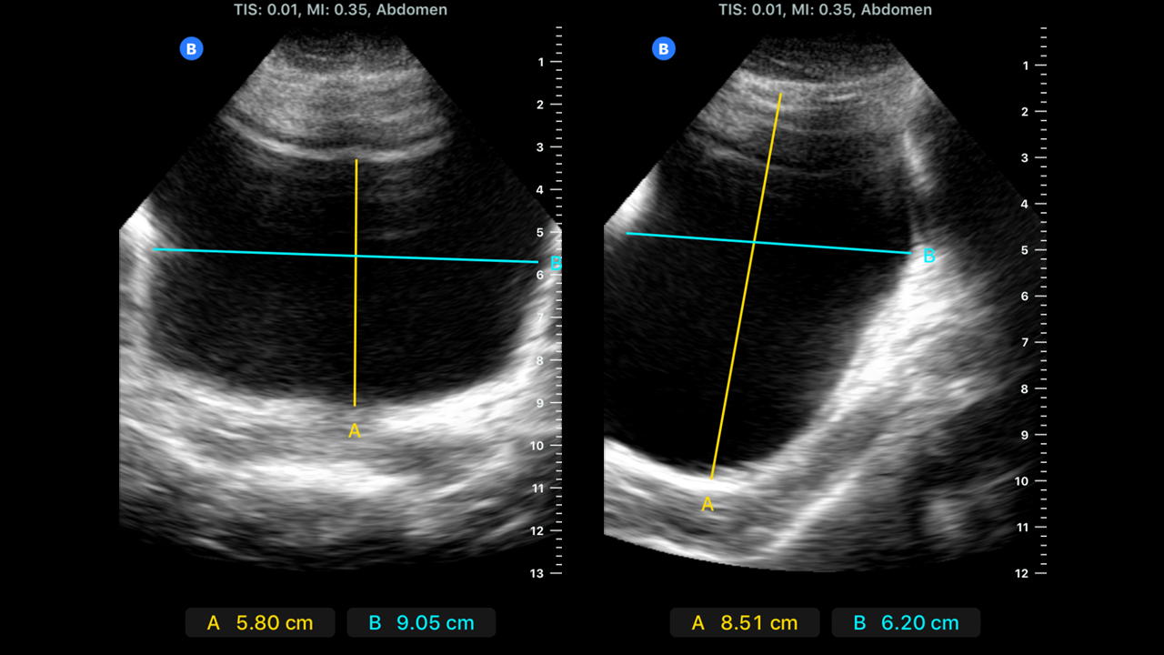 <p>Bladder Dimensions Visualized on Ultrasound