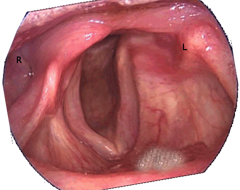 <p>Unilateral Vocal Cord Paralysis After a Left Parathyroidectomy