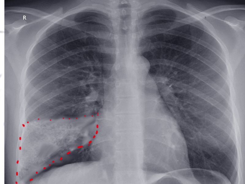 Wedge shape pulmonary infarction seen on AP chest x-ray.