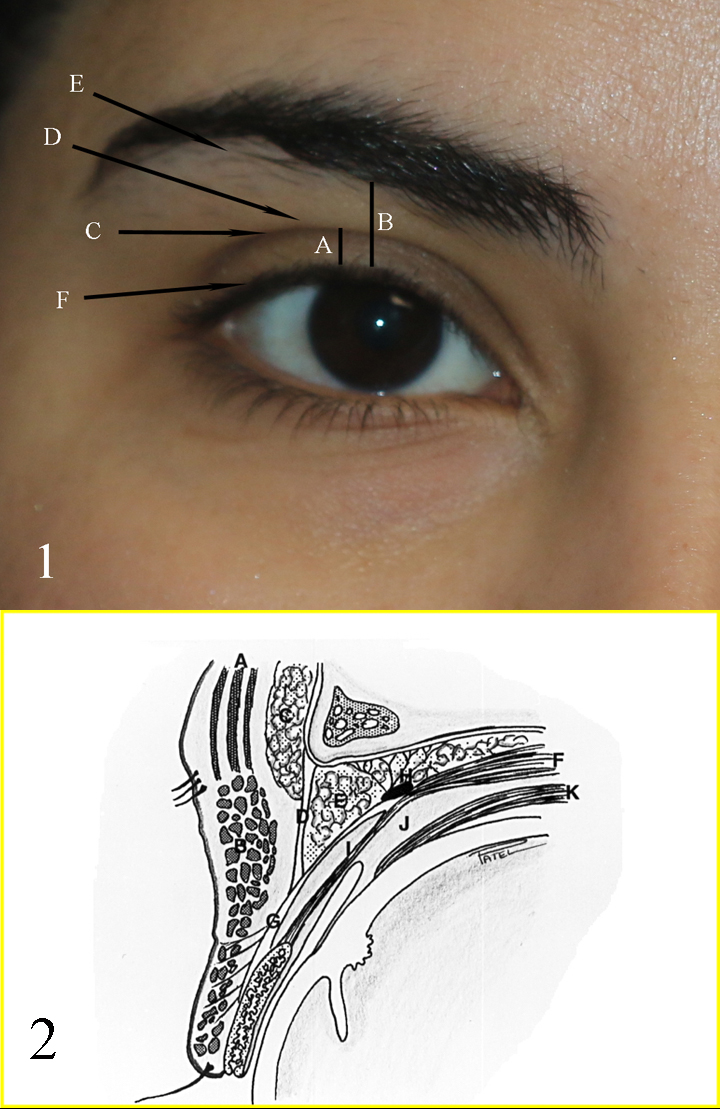 Fig 1: A: upper eyelid platform; B: Brow to Lid margin distance; C: Upper eyelid crease; D: Upper eyelid fold; E: Brow fatpad