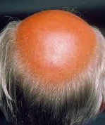 <p>Male-Pattern Androgenetic Alopecia. Photo of typical hair loss in males with androgenetic alopecia.</p>