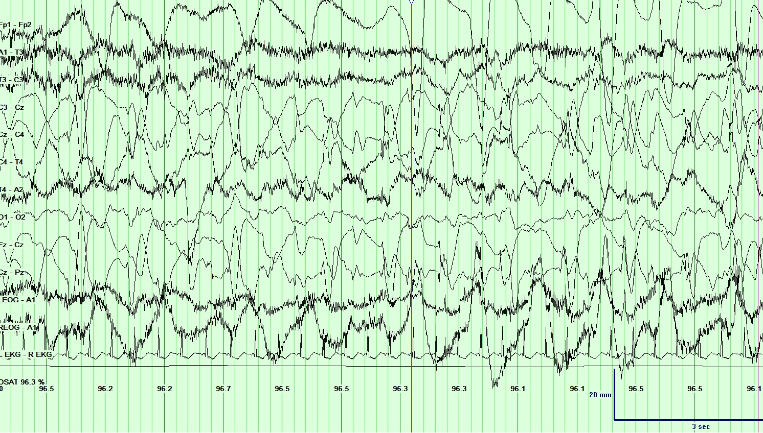 <p>Electroencephalogram (EEG), Neonatal Seizure. This EEG is characteristic of a neonatal seizure.</p>
