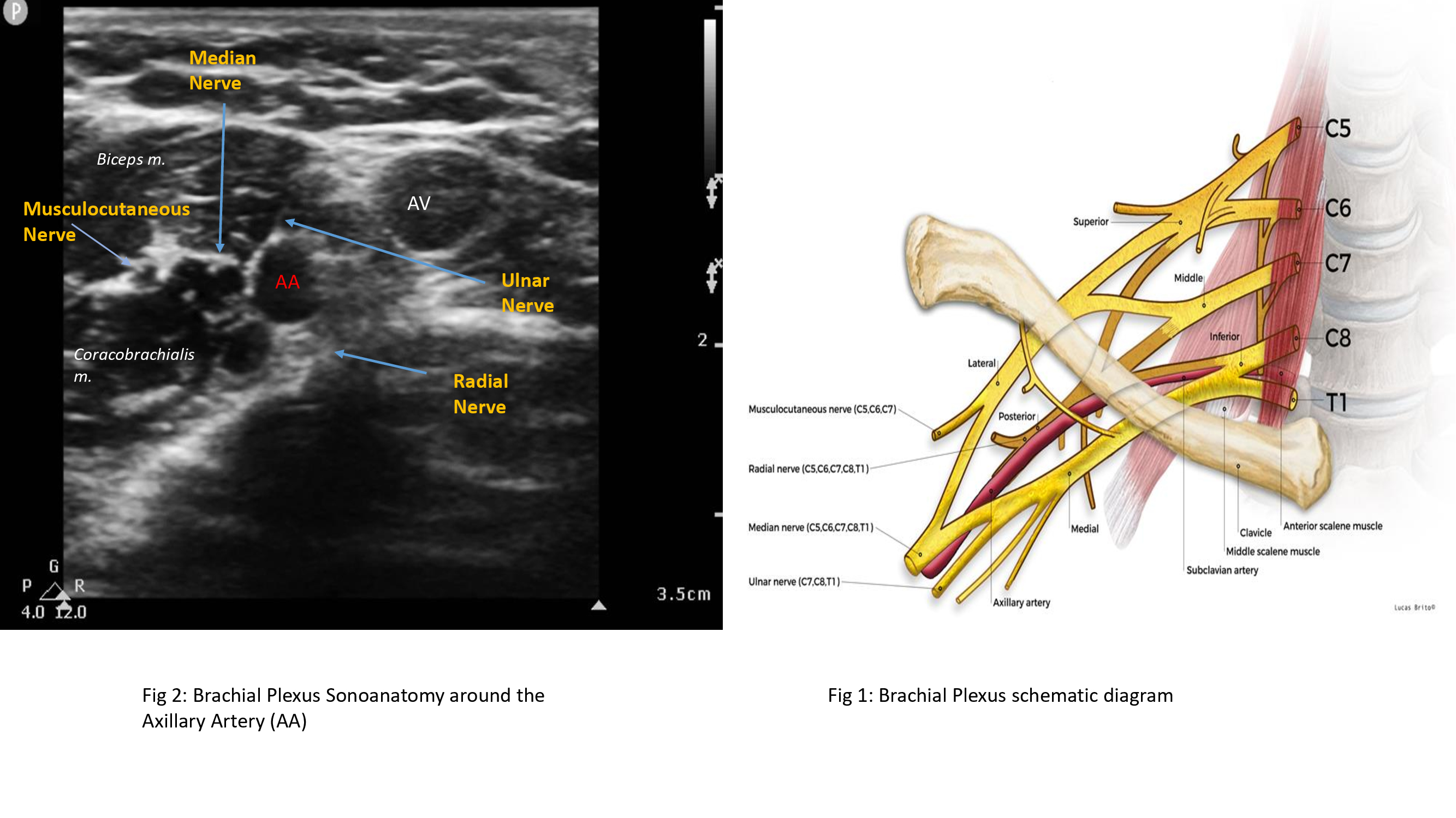 Fig 1: Schematic diagram of brachial plexus
Fig 2: Ultrasound image of the brachial Plexus at the level of axillary artery