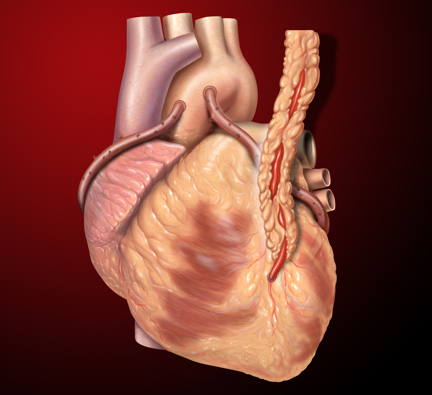 Three coronary artery bypass grafts