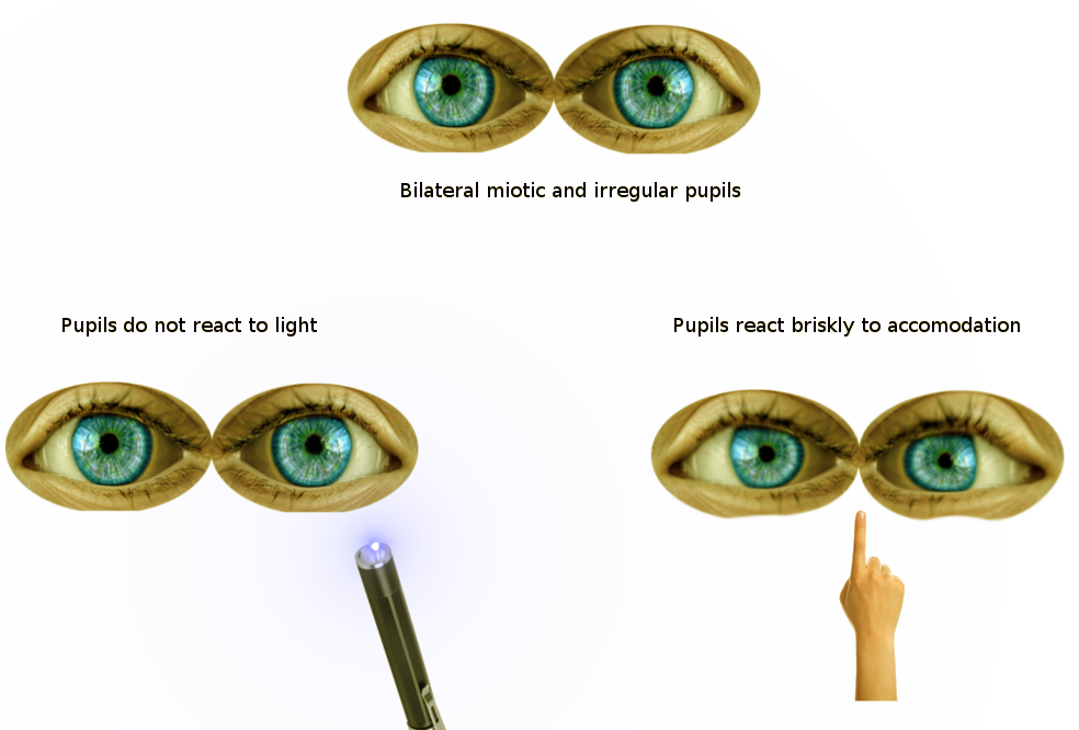 <p>Findings of Argyll Robertson Pupils on Pupillary Reflex Exam