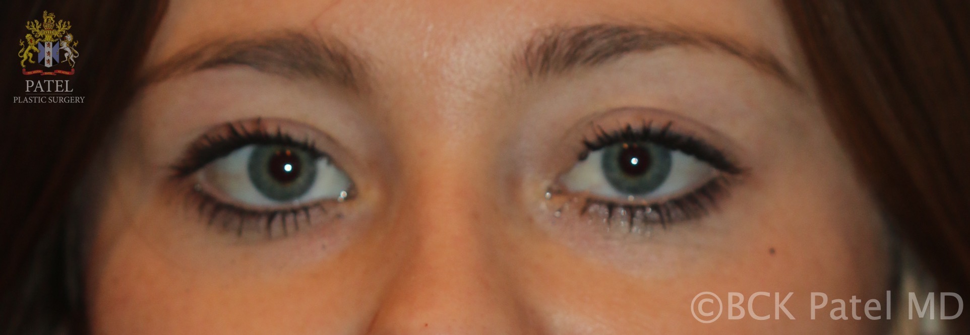 Normal eyelids in a young white woman