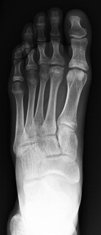 <p>Freiberg Frontal X-ray. Frontal radiograph revealing avascular necrosis of the 2nd metatarsal head.</p>