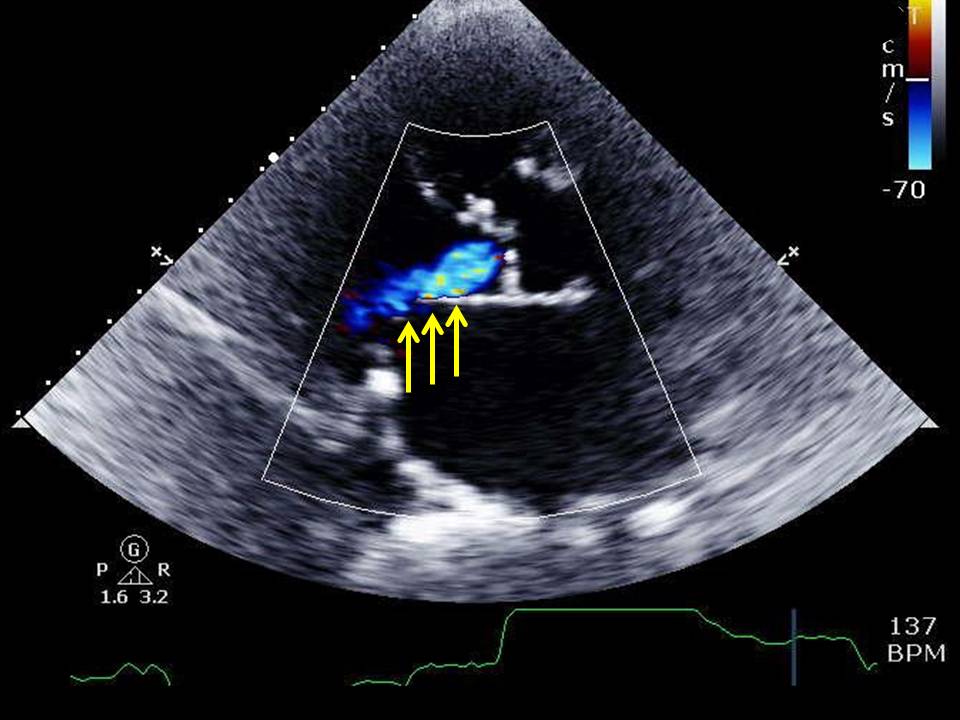Parasternal long axis echocardiographic view of aortic insufficiency (yellow arrows) striking the anterior mitral leaflet in an 85 year old woman with concomitant aortic stenosis presenting with shortness of breath