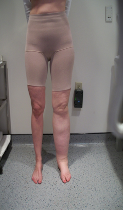 <p>Secondary Lymphedema. Lymphedema related to cervical cancer treatment.</p>
