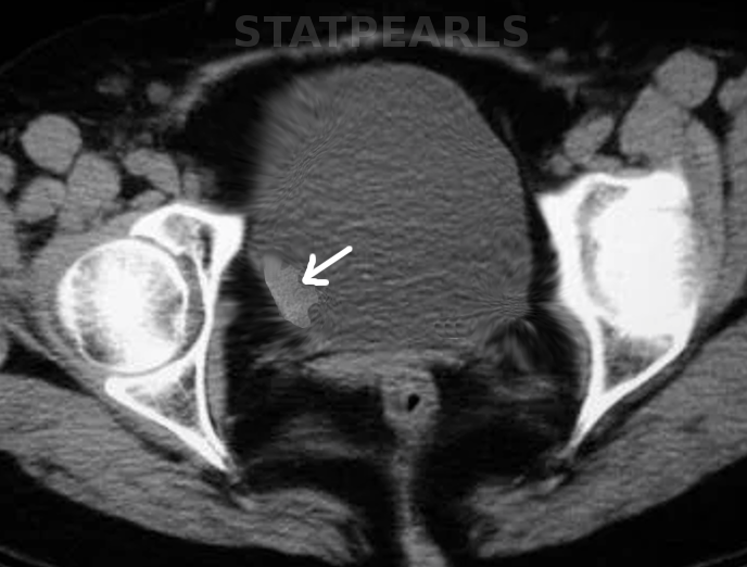 <p>Bladder Cancer, Magnetic Resonance Image. The arrow points to cancer cells growing on the lateral side of the bladder.</p>