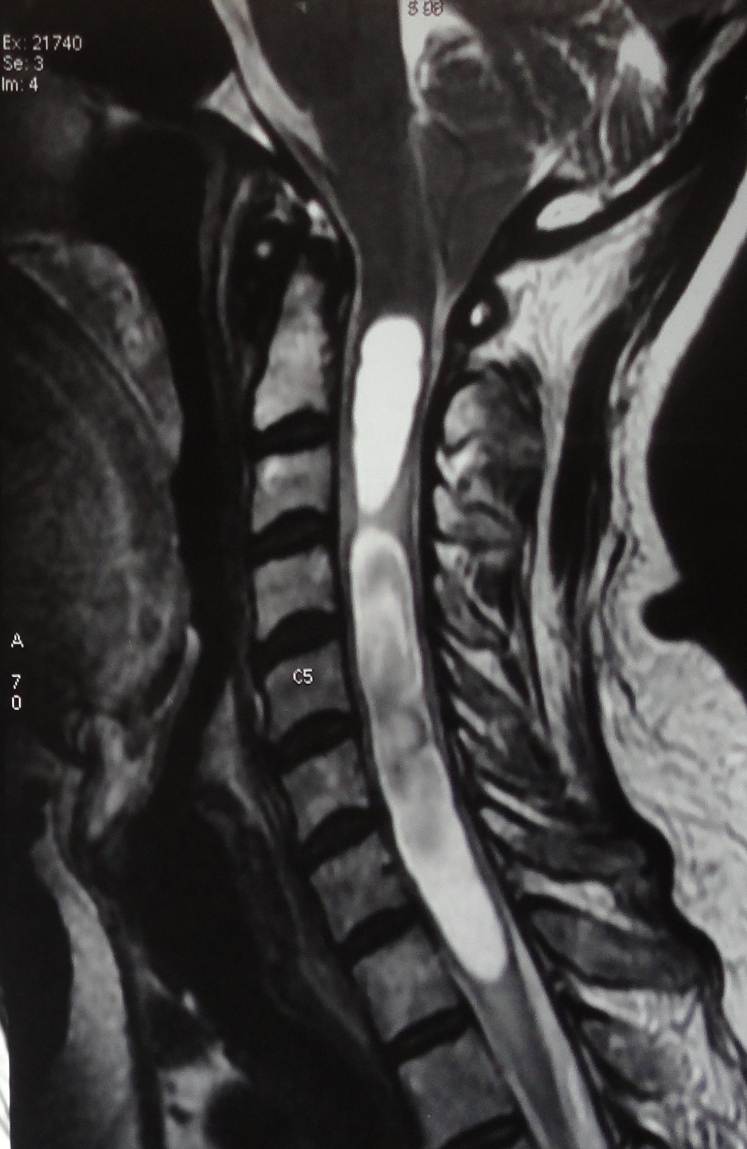 <p>Syringomyelia Visualized on MRI in a Patient With Hindbrain Herniation.</p>