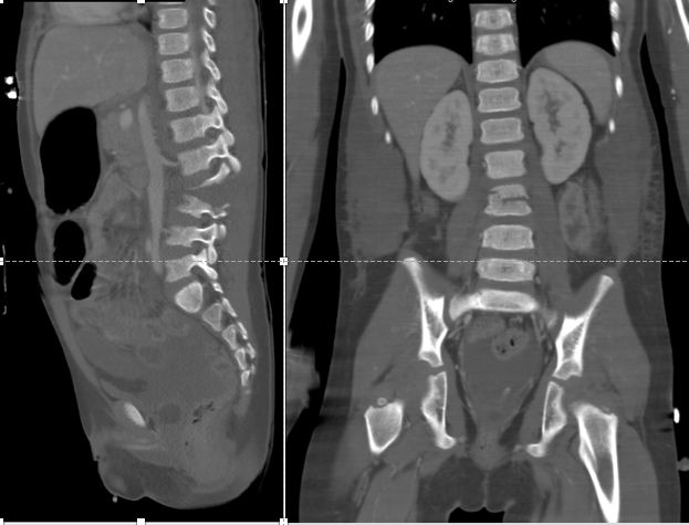 Sagittal and coronal CT images in a 5 year old boy with Chance fracture sustained in a motor vehicle collision while wearing a lap belt