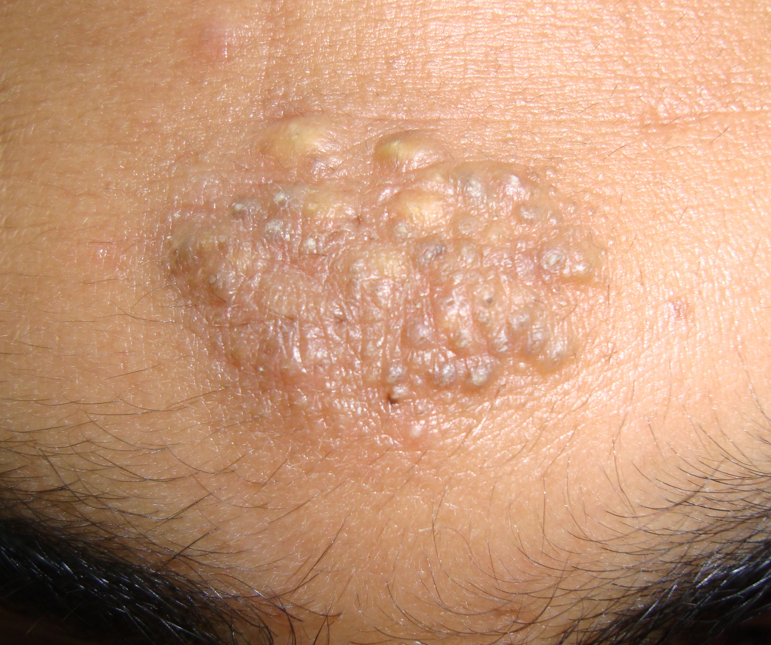 Nevus comedonicus over the forehead