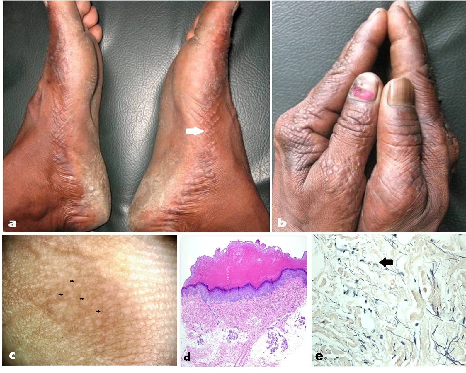 Fig 1 (a) Clinical Picture of Acrokeratoelastoidosis (AKE) of Costa involving the feet