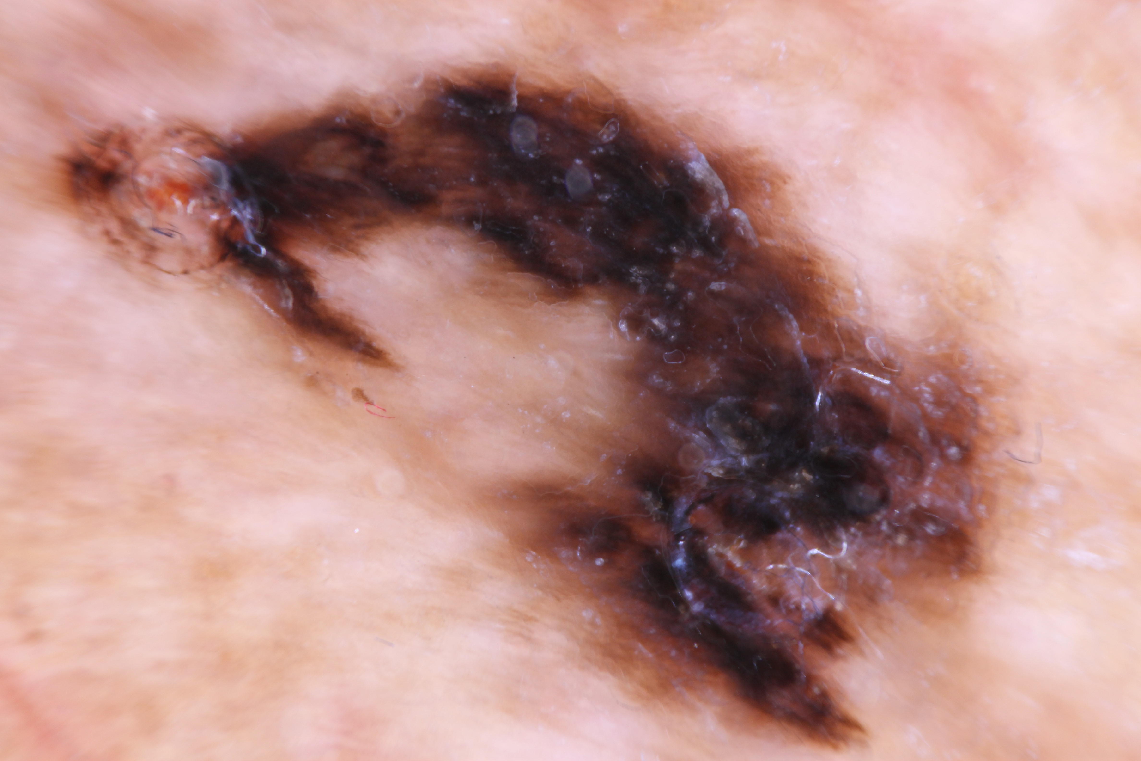 <p>Asymmetric Parallel Ridge Dermoscopic Pattern Indicative of Acral Lentiginous Melanoma on the Heel of a 62-Year-Old Male
