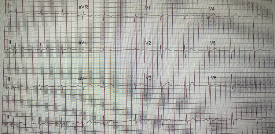 <p>12-Lead&nbsp;Electrocardiogram, Sinus Arrhythmia</p>