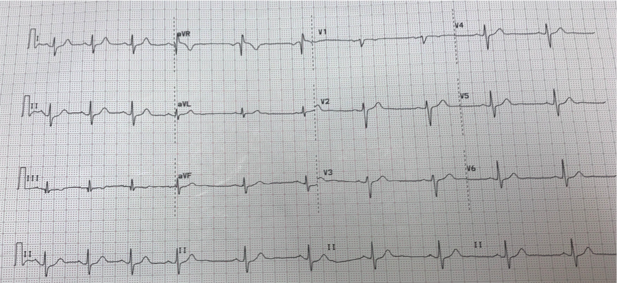 <p>12-Lead&nbsp;Electrocardiogram&nbsp;Displaying Sinus Arrhythmia</p>