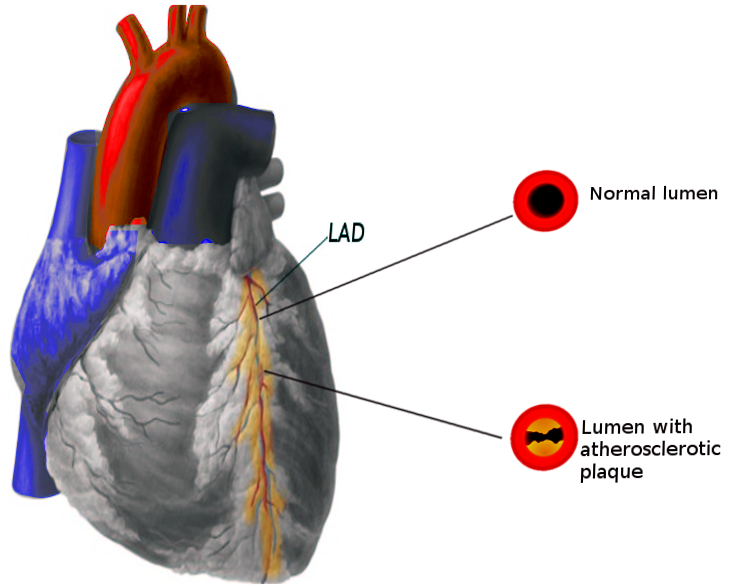 <p>Coronary Artery Disease Pathophysiology