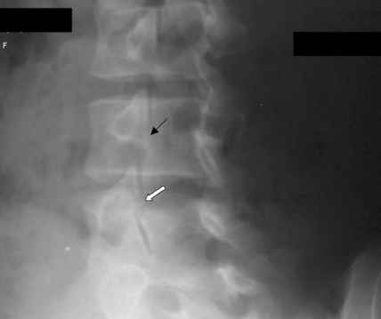 Oblique plain radiograph of the lumbar spine