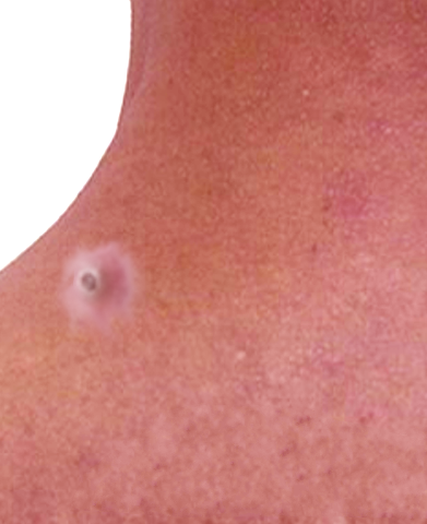 <p>Dilated Pore of Winer</p>